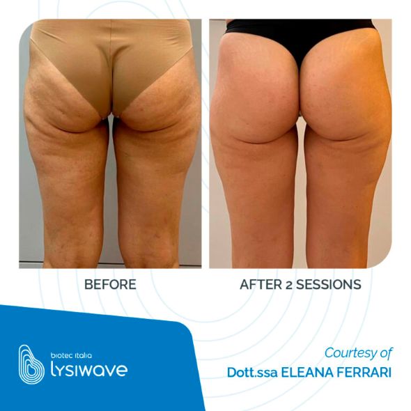 LYSIWAVE_Before-After_11_low