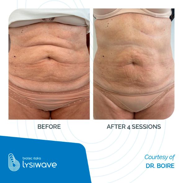 LYSIWAVE_Before-After_14_low