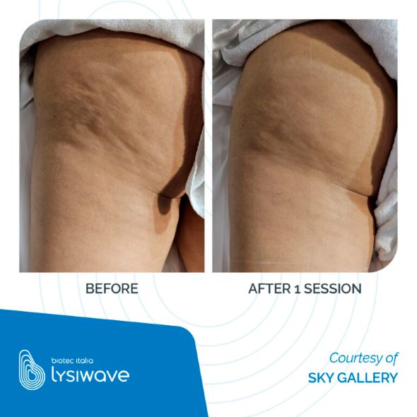 LYSIWAVE_Before-After_2_low